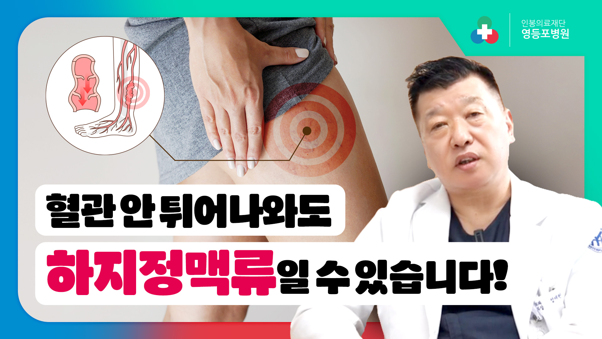 다리가 자주 붓고 쥐가 난다면? 하지정맥류 초기 신호일 수 있습니다 [영등포병원]