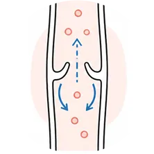 판막 기능 저하 일러스트