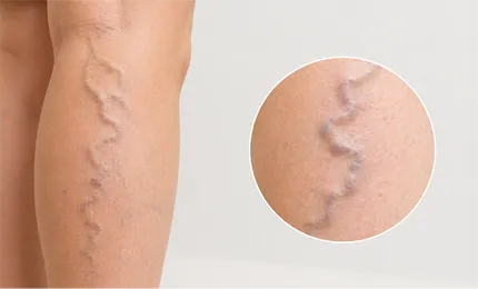 표재성 하지정맥류 다리 사진